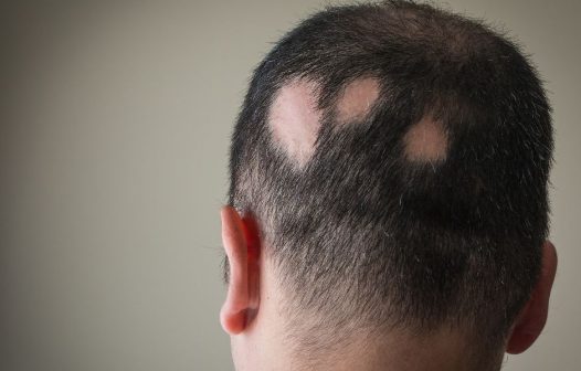 Anvisa aprova novo remédio para tratamento de alopecia areata