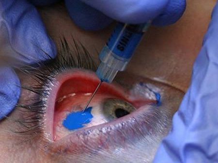 Médicos alertam para riscos de cirurgia de mudança da cor dos olhos