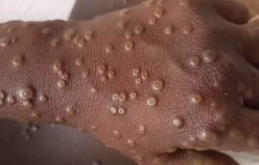 Brasil ultrapassa um mil casos de mpox e supera total de registros de 2023