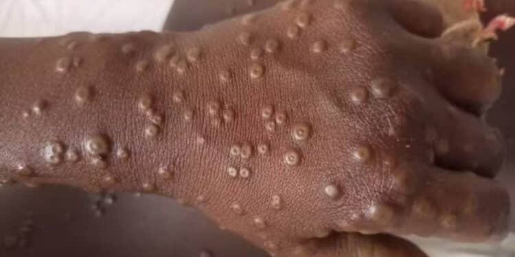 Brasil ultrapassa um mil casos de mpox e supera total de registros de 2023